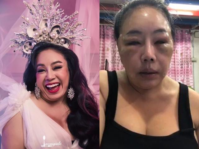 Nữ đại gia tuyển chồng yêu 28 lần/ngày xuất hiện với gương mặt sưng phù vì bị chồng đánh đập?