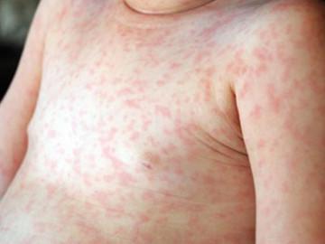 Thấy con bị sốt, nổi ban, mụn nước toàn thân, cha mẹ cần nghĩ ngay đến bệnh này