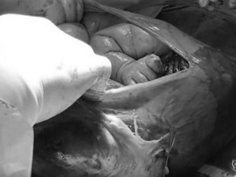 Sau khi được đưa ra khỏi bụng mẹ, túi ối sẽ được các bác sĩ nhẹ nhàng rạch ra để bé được trực tiếp tiếp xúc với thế giới bên ngoài và hít thở không khí. 
