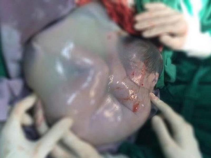 Một trong hai bé song sinh của một bà mẹ ở TP.HCM chào đời còn nằm trong bọc ối. 
