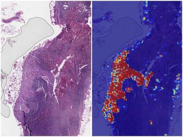 Trí tuệ nhân tạo của Google có thể phát hiện ung thư vú di căn hiệu quả hơn bác sĩ