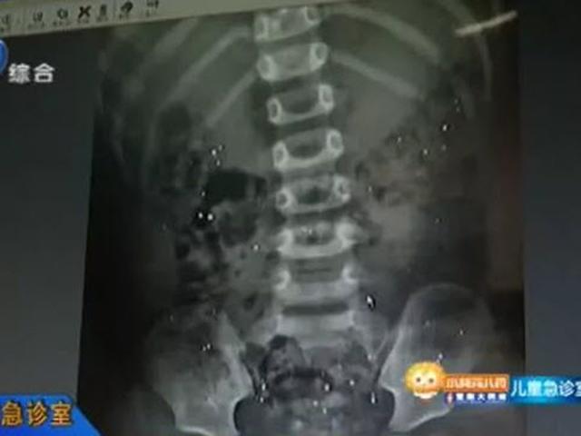 Con cắn vỡ nhiệt kế thủy ngân, cha mẹ lạnh người khi nhìn phim chụp X-quang