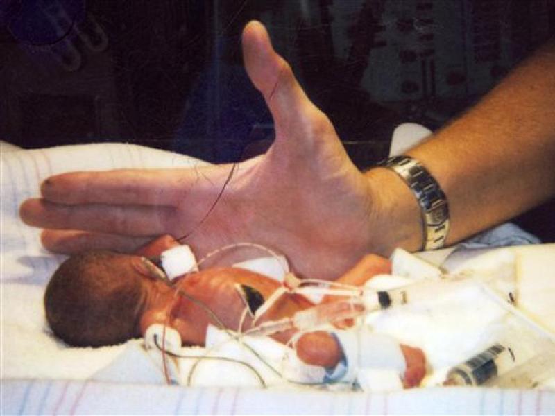 Em bé sơ sinh nhẹ cân nhất còn sống sót được sách kỷ lục Guiness ghi nhận là bé Rumaisa Rahman (sống tại Illinois, Hoa Kỳ). Cô bé nặng vỏn vẹn 260g khi chào đời sau 25 tuần 6 ngày thai kỳ. 
