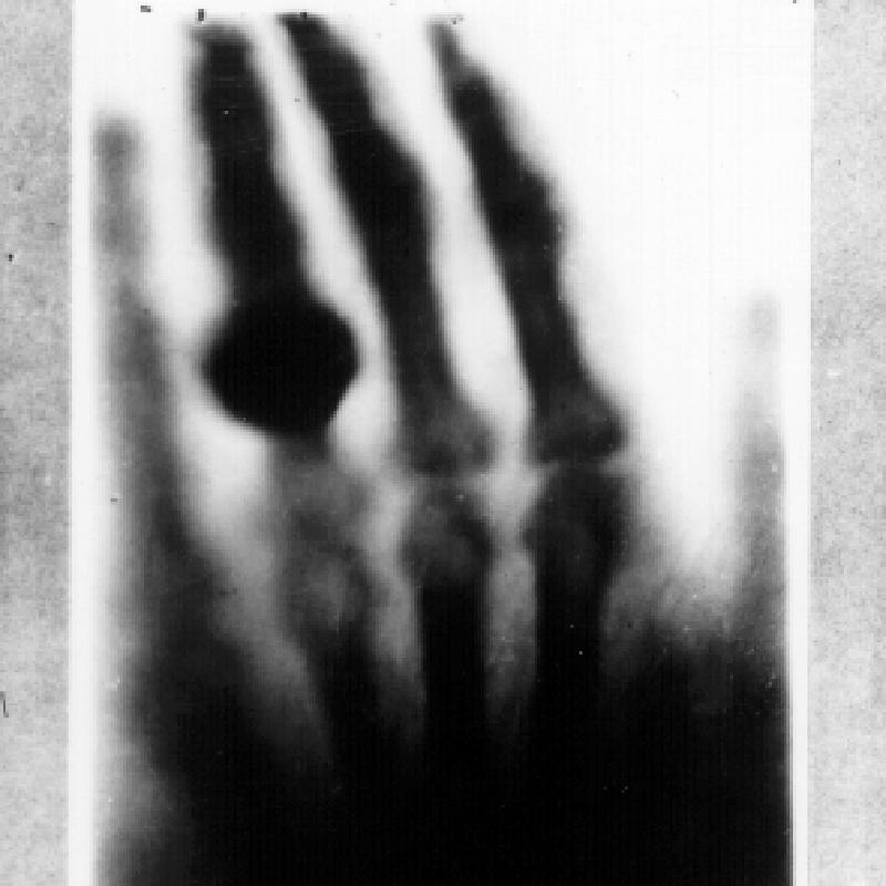 Đây là bức ảnh chụp bằng máy X-quang đầu tiên trên thế giới, được chụp bởi Wilhelm Röntgen vào ngày 22 tháng 12 năm 1895.
