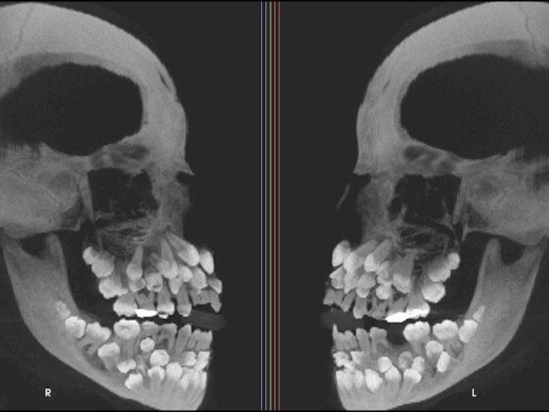 Hình ảnh của một bệnh nhân mắc chứng bệnh mọc thừa răng (Multiple Hyperdontia). Một người gặp tình trạng có nhiều hơn 20 chiếc răng sữa hoặc nhiều hơn 32 răng vĩnh viễn gọi là mọc thừa răng.
