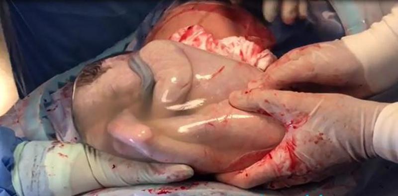 1. Hai em bé ngủ ngon trong túi ối

Hôm 7/9/2018, bác sĩ Rodrigo da Rosa Filho đã đăng tải clip một ca sinh 3 vô cùng đặc biệt, trong đó 2 em bé vẫn còn ngủ ngon trong túi ối khi chào đời. Bình thường khi sinh ra, túi ối sẽ vỡ rồi em bé mới chào đời.
