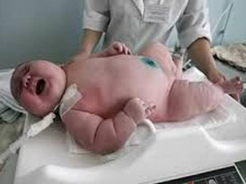 3. Bé sơ sinh chào đời nặng 18 kg

Thông thường, cân nặng của trẻ sơ sinh chỉ từ 2,5 – 4,5 kg nhưng một bé trai đã gây sốc nặng khi chào đời với 18 kg. Ca sinh đặc biệt này được diễn ra vào ngày 4/6/2015 tại Bệnh viện King Edward Memorial, nước Úc.
