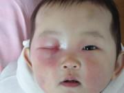 Làm mẹ - Bé sơ sinh 3 tháng suýt hỏng mắt chỉ vì bà nội nghe lời hàng xóm mách mẹo chăm cháu