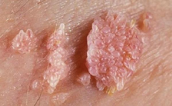 Trai trẻ amp;#34;vỡ mộngamp;#34; vì mắc sùi mào gà do quan hệ đồng tính với sếp - 2