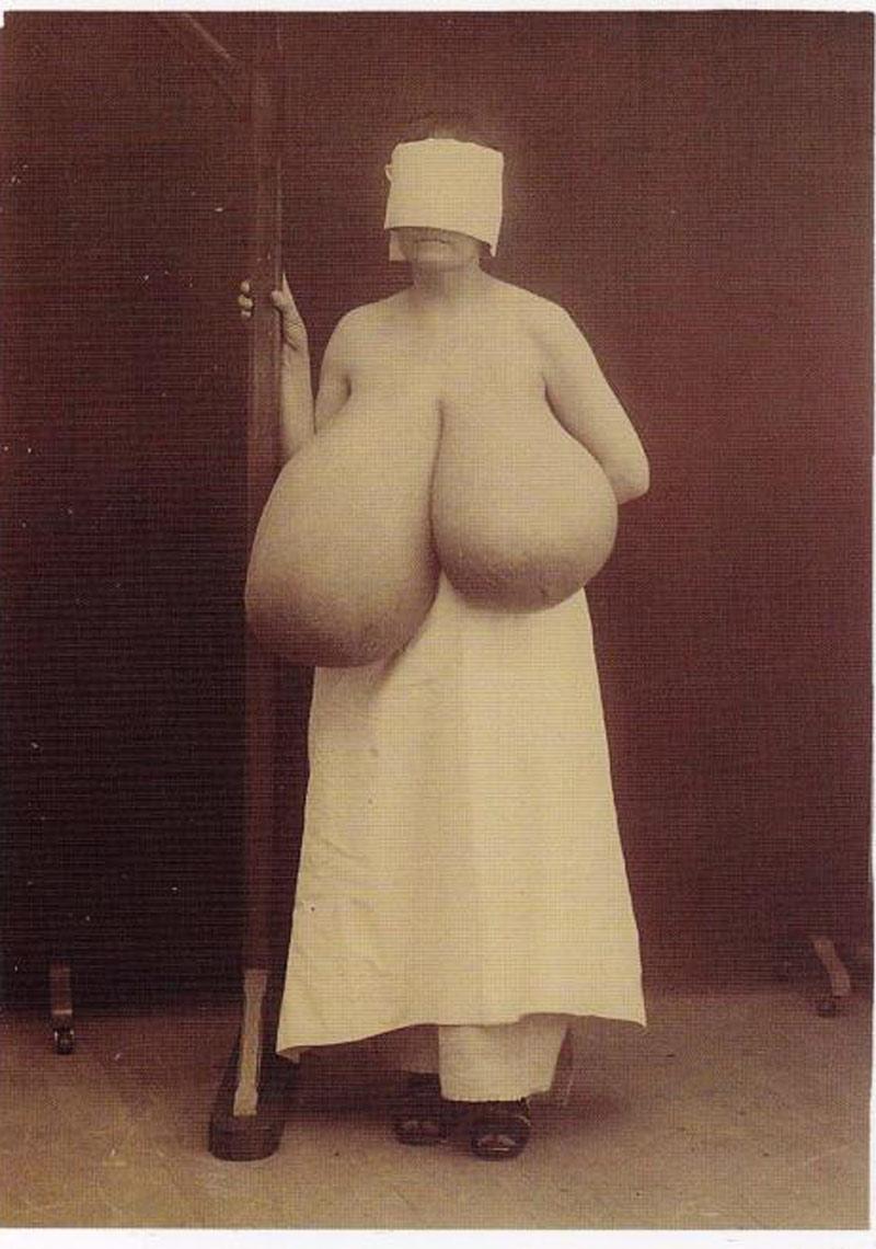 Người phụ nữ mắc chứng phì đại hai bên ngực, ngực bên trái nặng gần 8kg và bên phải nặng tới hơn 19kg. Sau đó cô đã được phẫu thuật để loại bỏ chúng. 

