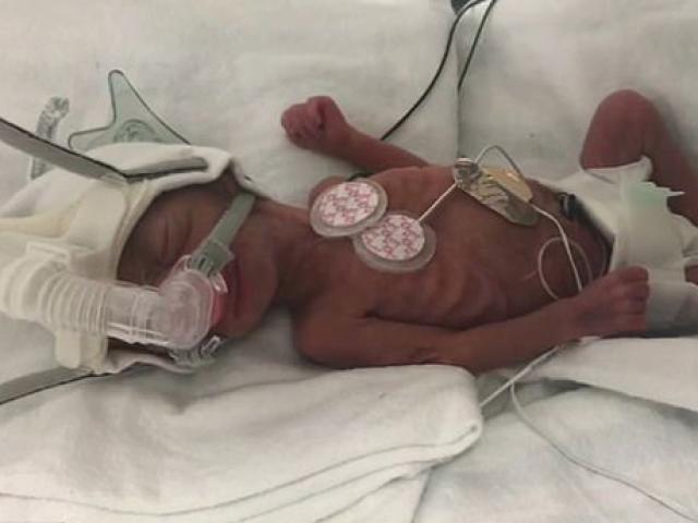Hành trình vượt cửa tử của bé gái sinh non trước 13 tuần, nặng vỏn vẹn 0,45kg