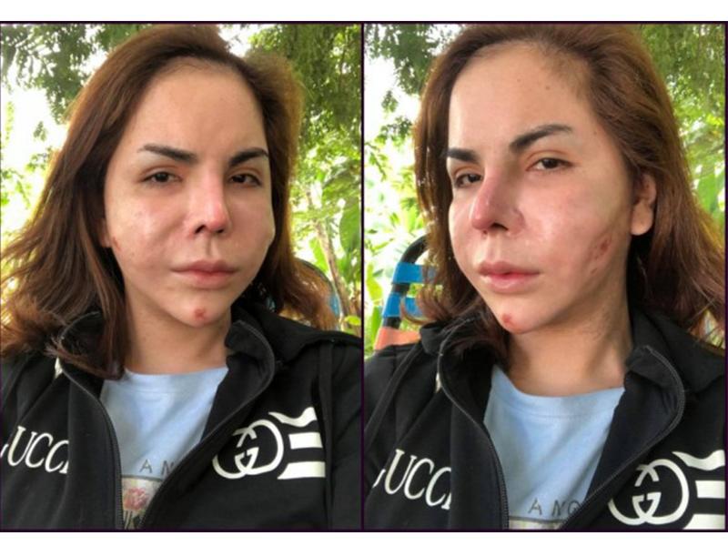 Linda - 1 hotgirl chuyển giới với hàng triệu người follow gặp phải biến chứng với khuôn mặt biến dạng 70% sau khi nạo silicon.
