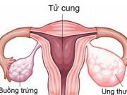 Sức khỏe - Hotgirl qua đời vì ung thư buồng trứng, chuyên gia cảnh báo dấu hiệu bệnh khi quan hệ tình dục