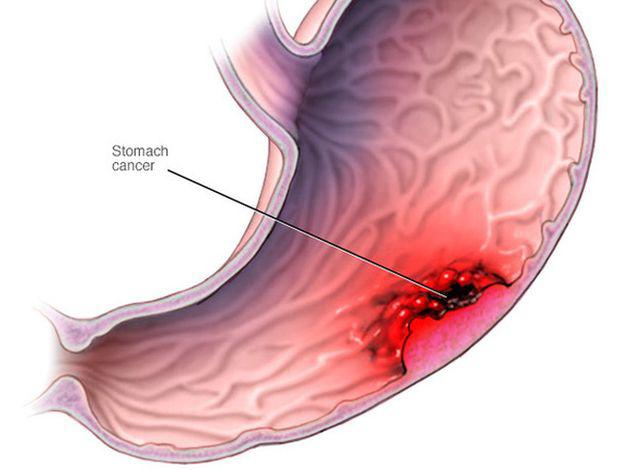 cau be 11 tuoi bi ung thu giai doan cuoi, cha me hay dung cho tre an do du thua - 4