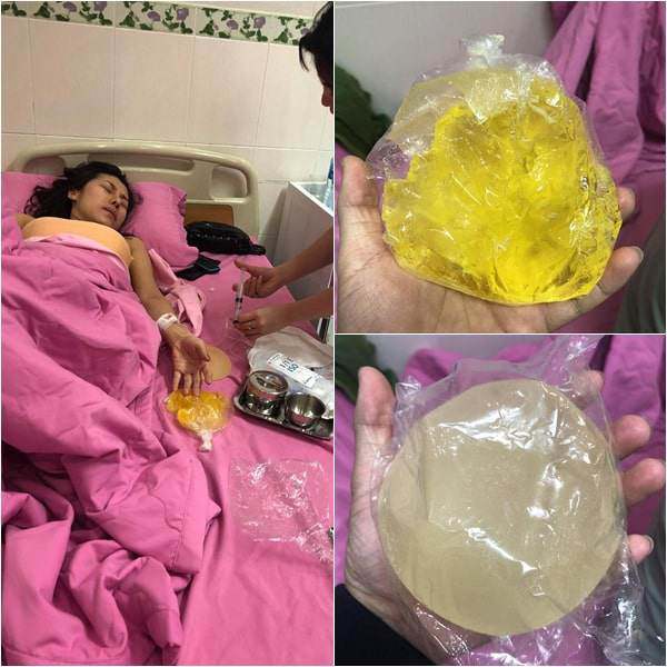 cau tra loi bat ngo tu chuyen gia: "tui nguc co the bi rach, thung,... chu khong the bi no!" - 2