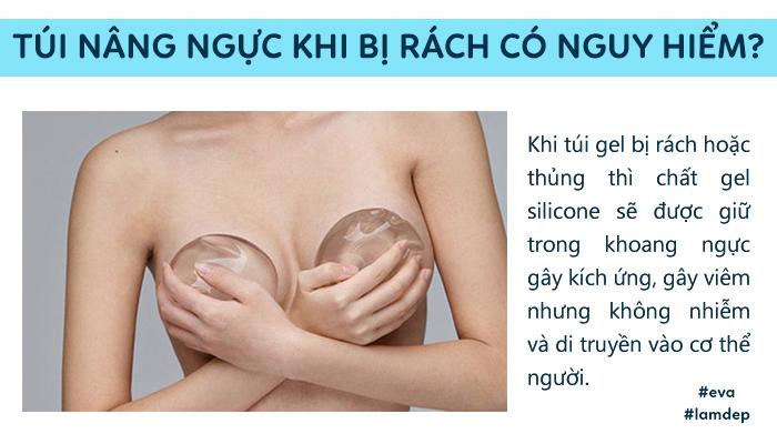 cau tra loi bat ngo tu chuyen gia: "tui nguc co the bi rach, thung,... chu khong the bi no!" - 5