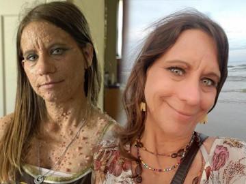 Dũng cảm cắt bỏ 6000 u thịt, cả thế giới bất ngờ về nhan sắc của người phụ nữ này