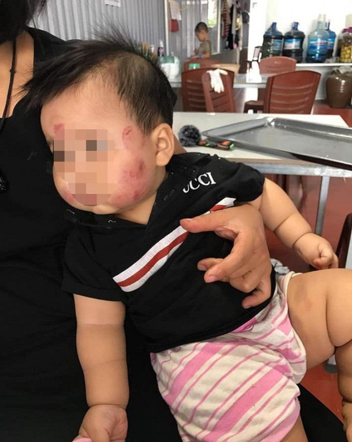 con 10 thang tuoi tim dui, mat nhieu vet thuong sau khi di hoc mam non: do “dong lech bim”? - 2