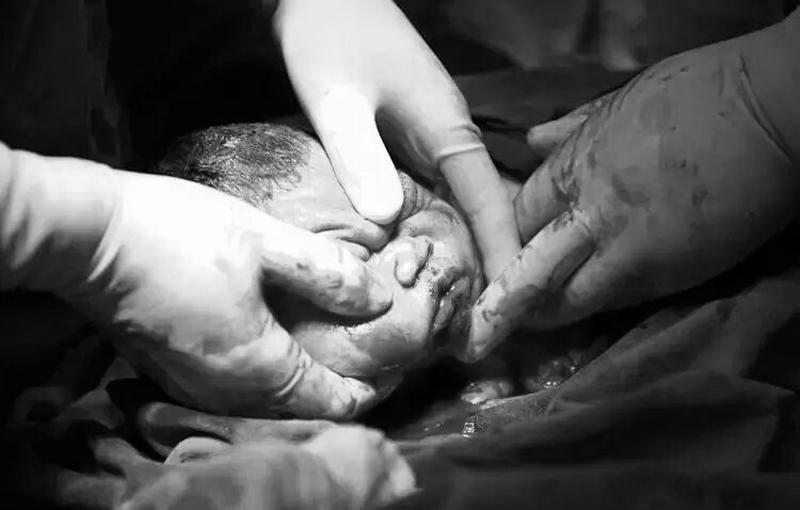 Bác sĩ kéo đầu em bé ra rồi dùng phương pháp chuyên khoa đặc biệt đè lên người mẹ để giúp đẩy nốt phần thân của bé ra. 
