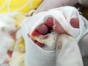 Sức khỏe - Chàng trai trẻ bị sốt 4,5 ngày không khám, tới viện khiến bác sĩ giật mình khi cởi giày ra