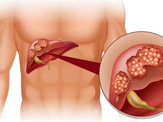 Lý do không thể ngờ khiến nhiều người Việt tử vong vì ung thư gan
