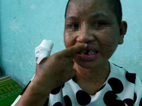 Thông tin mới vụ cô gái giúp việc 9X bị chủ hành hạ đến biến dạng, sảy thai