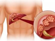 Sức khỏe - Lý do không thể ngờ khiến nhiều người Việt tử vong vì ung thư gan