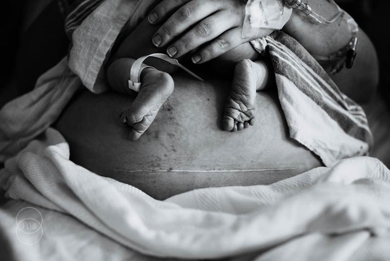 Em bé chào đời bằng phương pháp sinh mổ sẽ để lại trên cơ thể mẹ một vết sẹo dài. 
