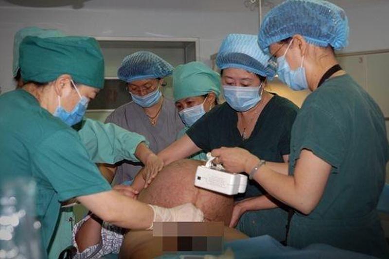 Bác sĩ đang kiếm tra tim thai trên chiếc bụng khổng lồ, xù xì trước khi chính thức phẫu thuật.

