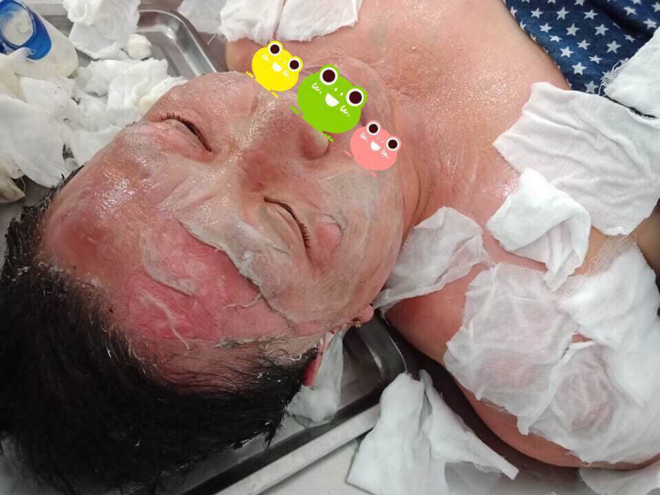 soc: co gai tuoi con bat lua xong da bi luoc chin mat, da troc thanh mang kho cuu van - 2