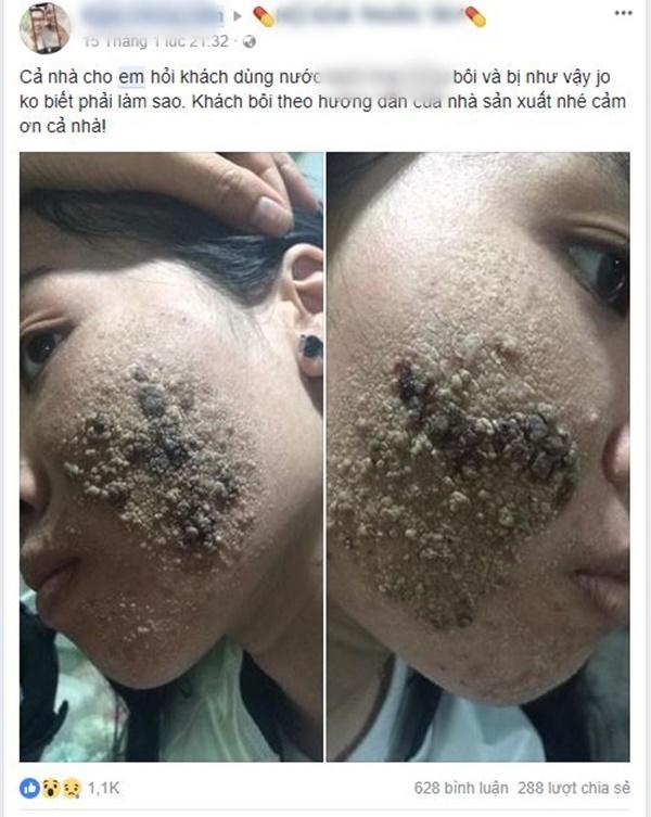 soc: co gai tuoi con bat lua xong da bi luoc chin mat, da troc thanh mang kho cuu van - 5