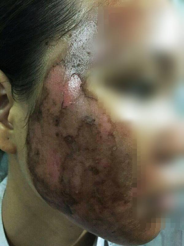 soc: co gai tuoi con bat lua xong da bi luoc chin mat, da troc thanh mang kho cuu van - 6