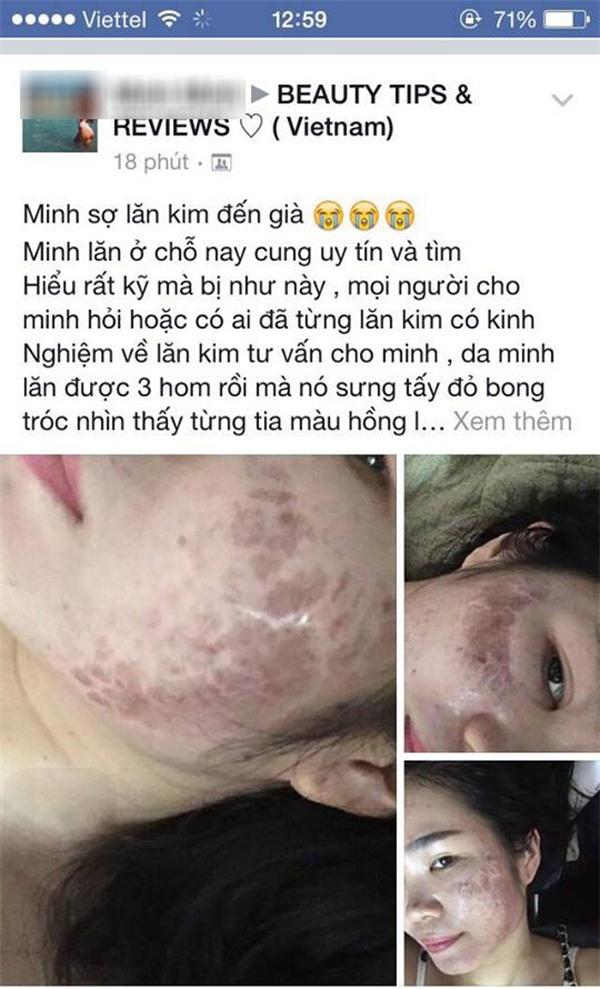 soc: co gai tuoi con bat lua xong da bi luoc chin mat, da troc thanh mang kho cuu van - 7