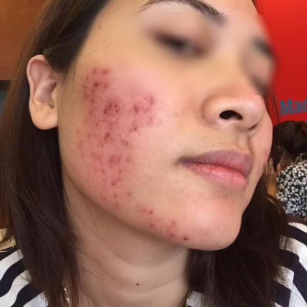 soc: co gai tuoi con bat lua xong da bi luoc chin mat, da troc thanh mang kho cuu van - 8