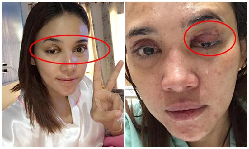 Không chỉ riêng Việt Nam, Thái Lan cũng ghi nhận trường hợp một cô gái gặp phải biến chứng hậu cắt mí. Không những phải chấp nhận vẻ ngoài trông có phần đáng sợ mà hơn nữa, cô gái này còn phải đối mặt với nguy cơ đôi mắt bên trong bị tổn thương, hạn chế tầm nhìn.
