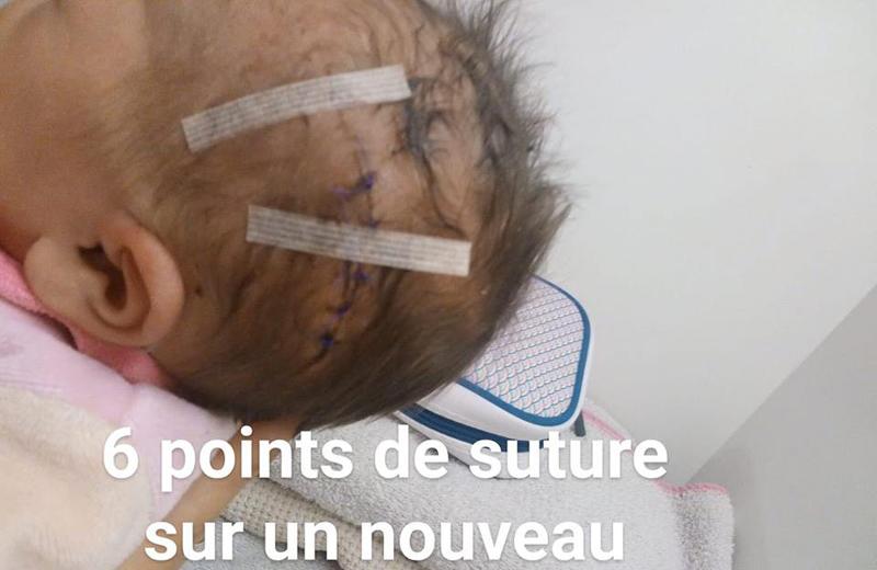 Một bé khác ở Pháp cũng bị bác sĩ rạch trúng đầu khi sinh mổ ngày 1/9 vừa qua. Vết thương của bé dài đến mức phải khâu tới 6 mũi. Tuy nhiên, điều khiến dư luận bức xúc là bác sĩ phẫu thuật không hề xin lỗi vì "chỉ thương ngoài da". 
