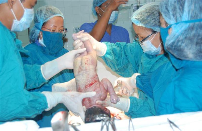 Không chỉ rạch trúng đầu em bé, nhiều tai nạn kinh khủng khác còn có thể xảy ra khi đẻ mổ. Năm 2016, một em bé tại An Giang đã bị gãy đùi khi bác sĩ cầm chân lôi ra ngoài trong quá trình sinh mổ. 
