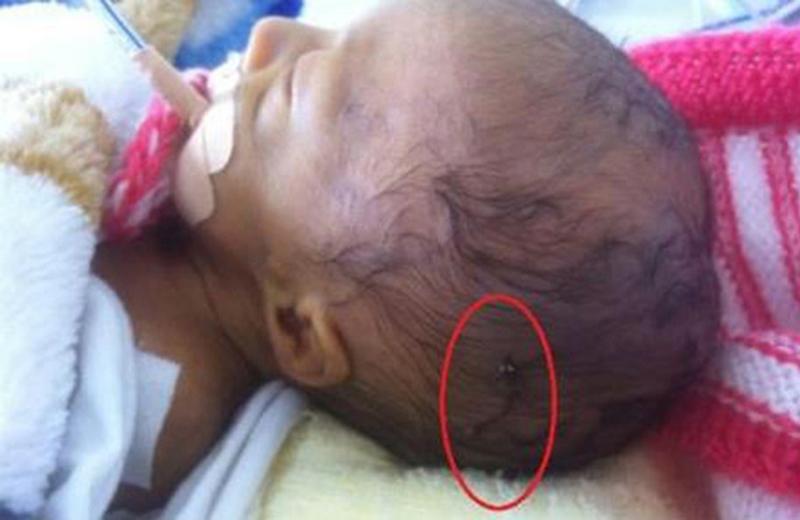 Ngày 5/6/2016, một em bé tại Đà Lạt đã bị bác sĩ rạch trúng đầu khi dùng kéo tách cơ tử cung của mẹ. May mắn vết thương chỉ dài 2cm, sâu 0,5mm và không gây nguy hiểm.
