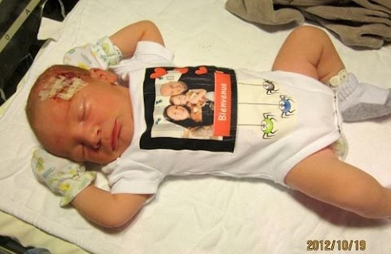 Hình ảnh bé Jeremy (ở Canada) với vết thương trên đầu gần trán do dao mổ đẻ gây ra. 
