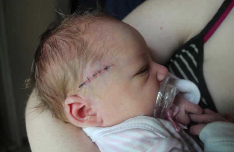 Một em bé khác ở Mpumalanga, Nam Phi cũng được cho là bị thương trong quá trình đẻ mổ đón bé chào đời. 
