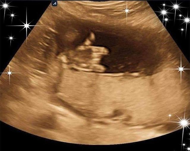 Đi siêu âm 20 tuần, mẹ Bắc Ninh amp;#34;tròn mắtamp;#34; kinh ngạc khi nhìn lên màn hình - 1