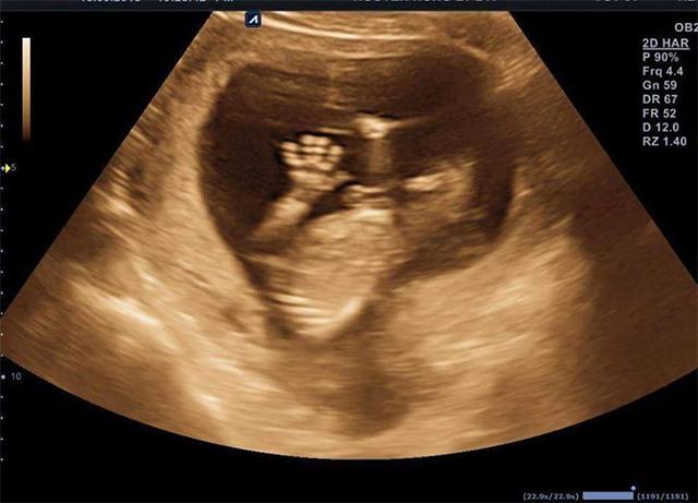 Đi siêu âm 20 tuần, mẹ Bắc Ninh amp;#34;tròn mắtamp;#34; kinh ngạc khi nhìn lên màn hình - 2