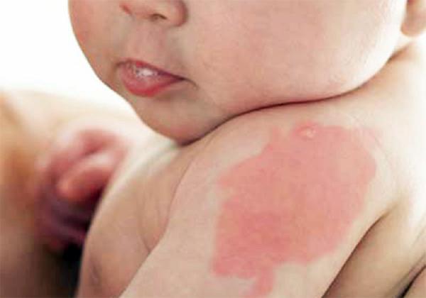 3 việc mẹ bầu nhớ tránh xa kẻo con sinh ra mang vết bớt chàm xấu xí - 2