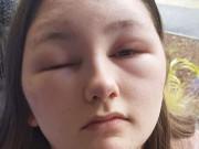 Sức khỏe - Cô gái 18 tuổi suýt mù vì quên làm một việc trước khi nhuộm tóc, chị em nên lưu ý