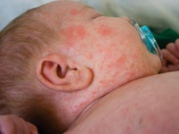 Bác sĩ Nhi chỉ cách nhận biết các triệu chứng sốt phát ban ở trẻ