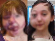 Làm đẹp - Biến dạng kinh khủng cả khuôn mặt vì tẩy nốt ruồi sai cách, chị em nên cảnh giác cao độ