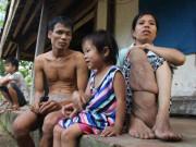 Tin tức - Cảm động chuyện tình “rổ rá” giữa cô nàng “chân voi” và anh chàng mù