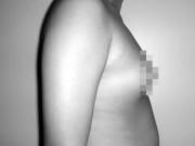 Sức khỏe - Cha sững người khi ngực con trai to như quả cam, không ngờ đi khám mắc bệnh hiếm gặp