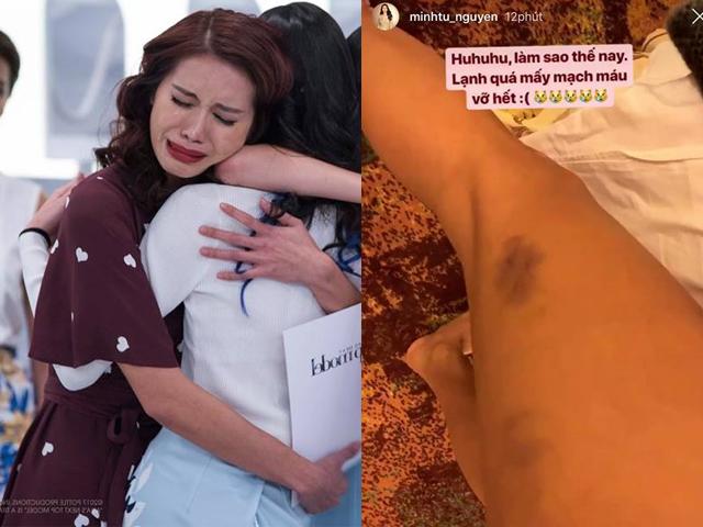 Minh Tú bị vỡ mạch máu, da nổi nhiều vết bầm tím, chị em cũng nên cẩn thận!