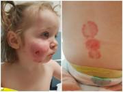 Làm mẹ - Bé gái 17 tháng bị thủng lỗ chỗ khắp mặt, thủ phạm gây ra khiến mẹ nào cũng kinh hoàng